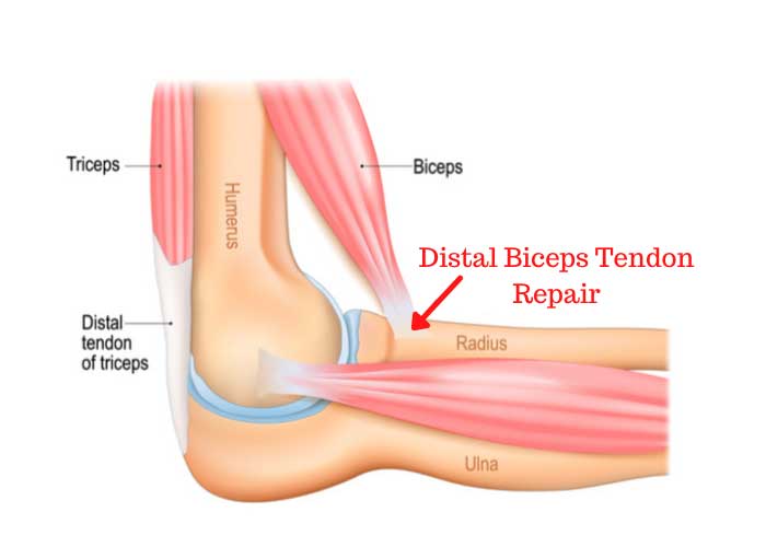 Distal Biceps Tendon Repair