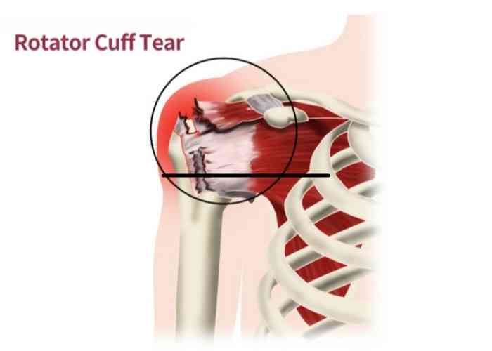 Rotator Cuff Tear