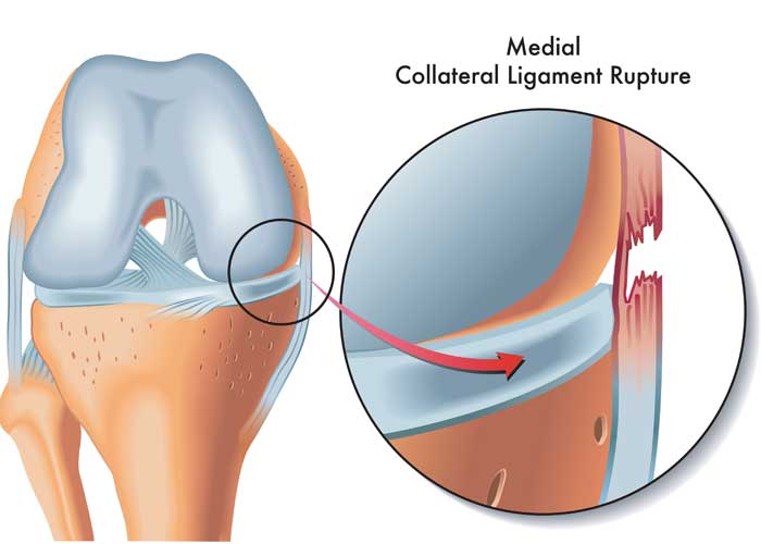 Medial Collarteral Ligament Tear Medial Collarteral Ligament Tear