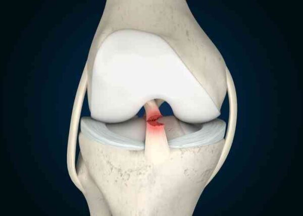 Pcl Human Posterior Cruciate Ligament Injury | PCL Specialist | Kildeer ...
