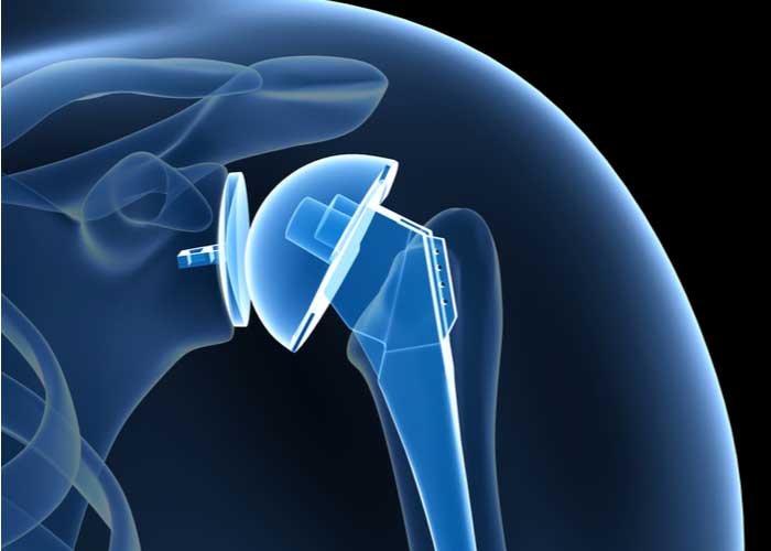 Total Shoulder Replacement