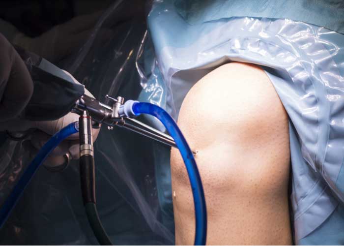 Knee Arthroscopy