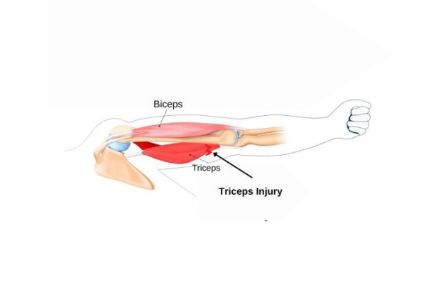 Triceps Injury or Tear