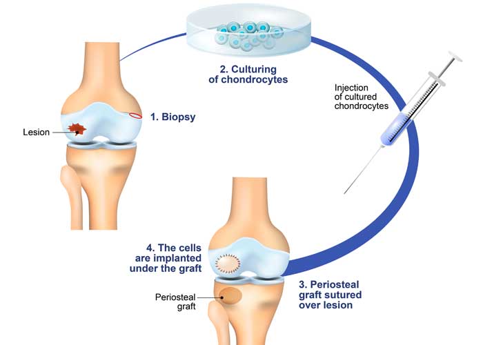 Autologous Chondrocyte Implantation