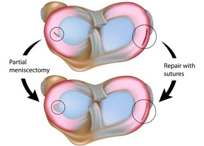 Meniscus Tear Repair