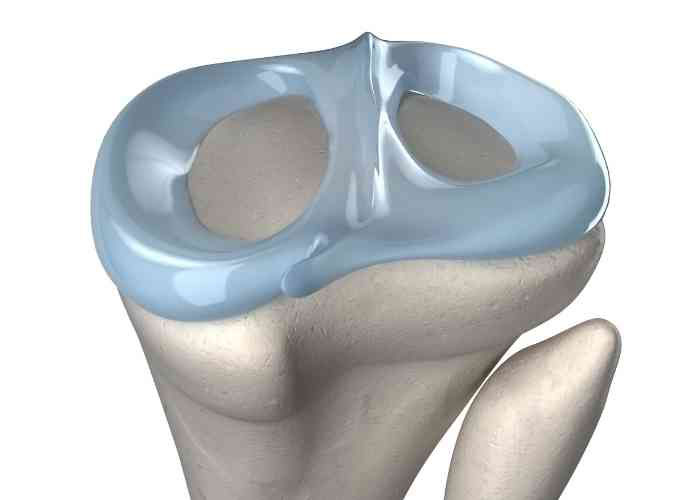 Meniscus Transplant