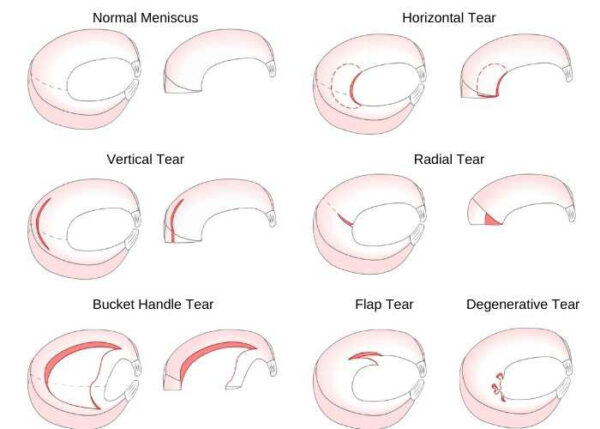 Meniscus Tear Types, Atlanta, GA
