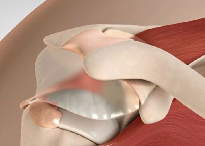 InSpace Balloon Implant | Atlanta GA