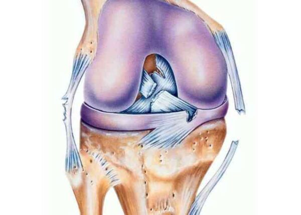 Multi-Ligament Knee Injury, GA