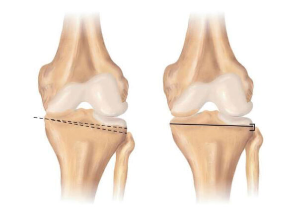 Osteotomy | Atlanta, GA