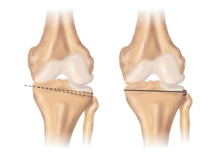 Osteotomy | Atlanta, GA