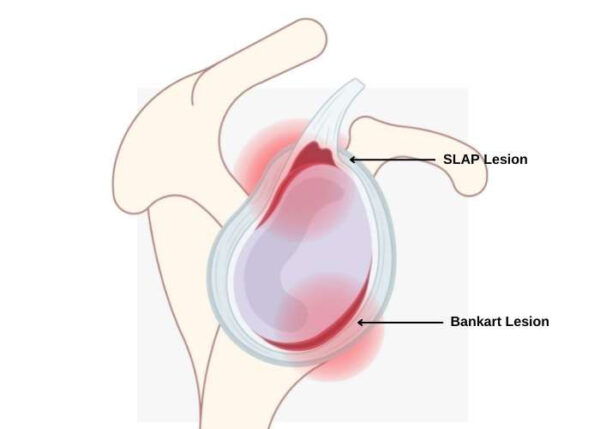 SLAP Lesion and Bankart Lesion | Atalanta, GA