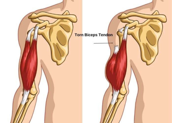 Torn Biceps Tendon | Atlanta, GA