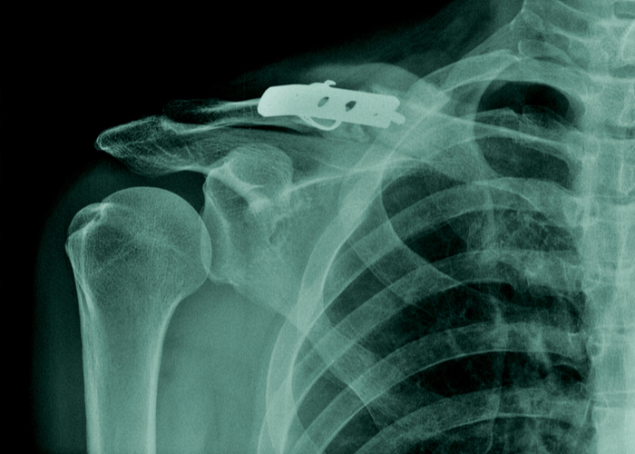 Clavicle Fracture Fixation | Atlanta GA