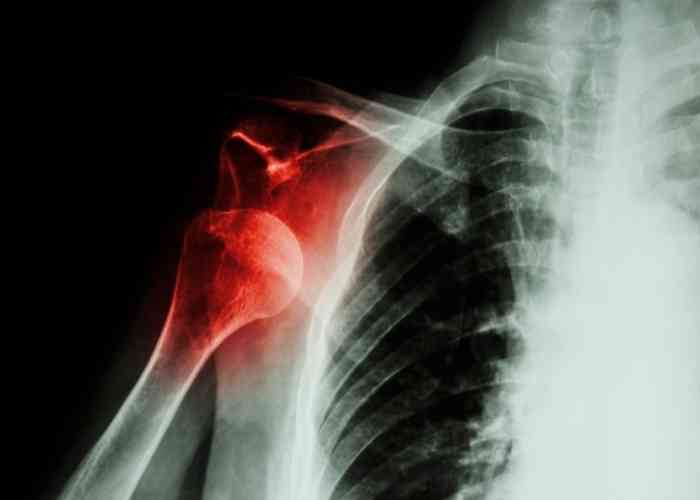 Shoulder Dislocation X-Ray | Orlando, FL