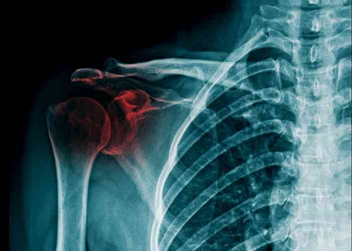 Fractures of the Shoulder | Atlanta GA