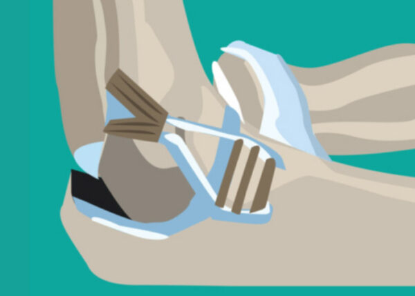 Example of Tommy John Surgery